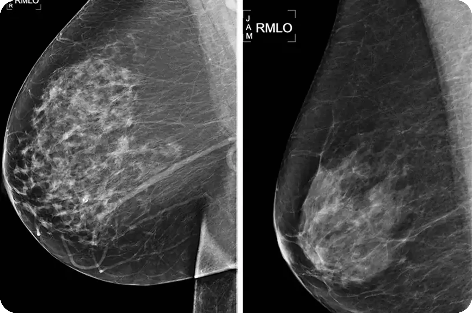 MAMMOGRAM AI