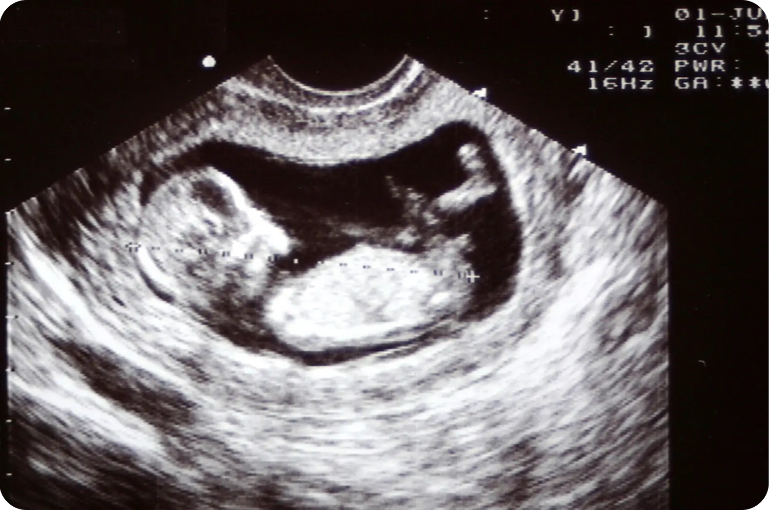ULTRASOUND AI